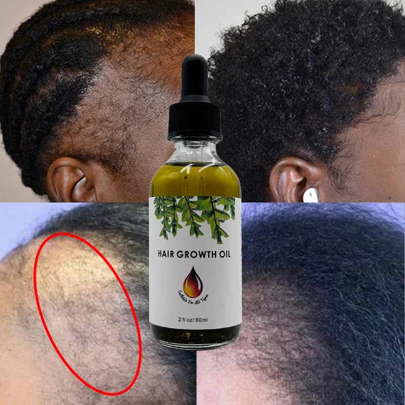 Scalp Japanese Onion Hair Fall Biotin Wholesale Babies Rosemary Oil Batana Oil Hair Treatment Set Hair Growth Oil